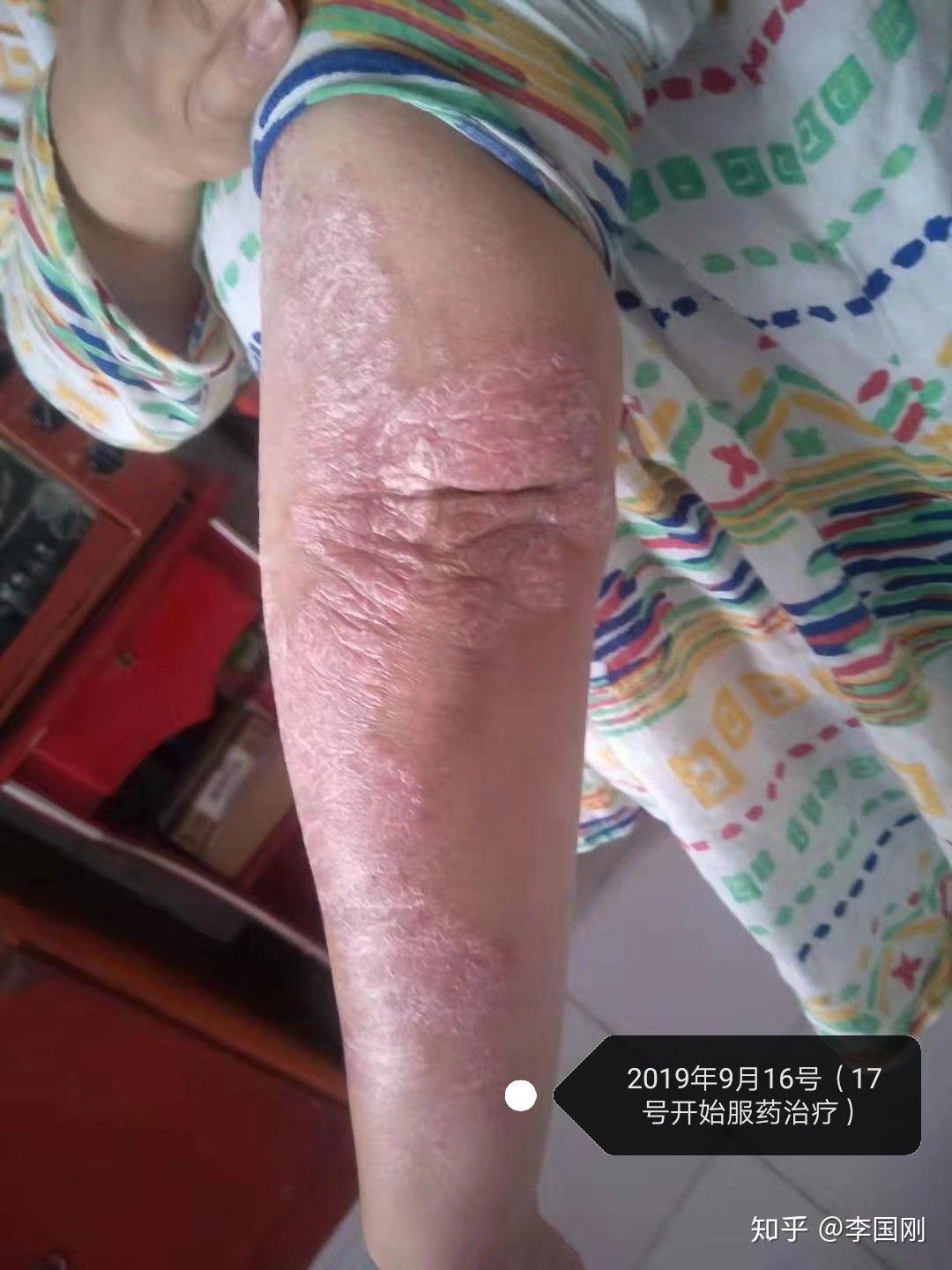 手臂块状消退顺序图片河北省唐山市