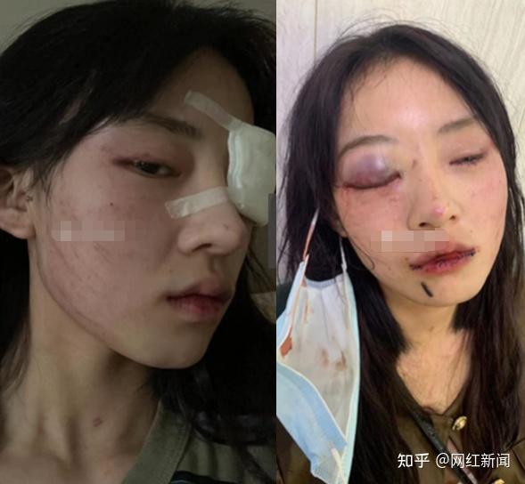 全身是血ks网红猪有蹄被家暴重伤面目全非众网红奔赴杭州陪伴