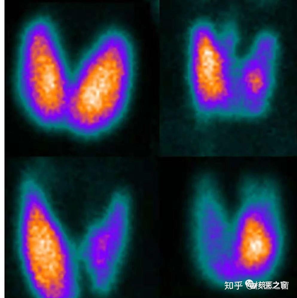 SPECT显像主要检查项目都有哪些? - 知乎