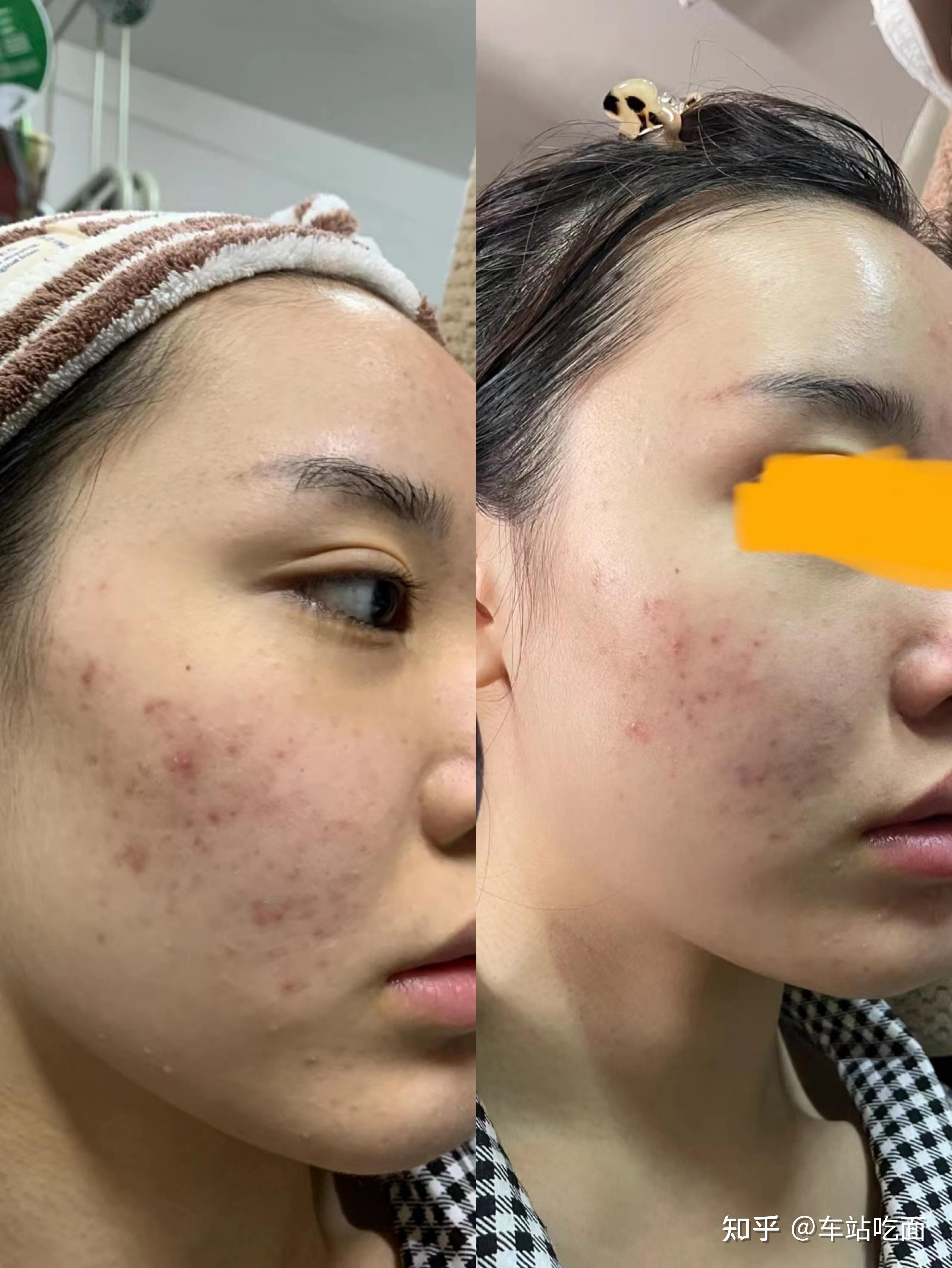 皮肤在什么情况下需要刷酸有哪些注意事项