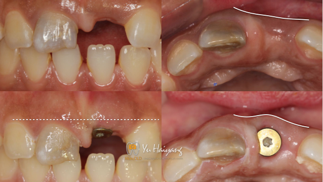 患者自述5年前拔除左上後牙,後於外院行隱形義齒修復,現要求種植主訴