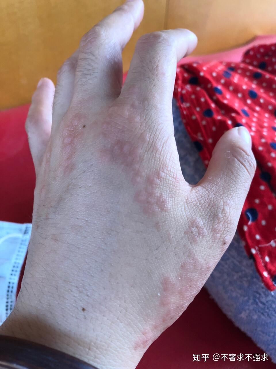 湿疹用什么药能治好不反复是长在手部的湿疹