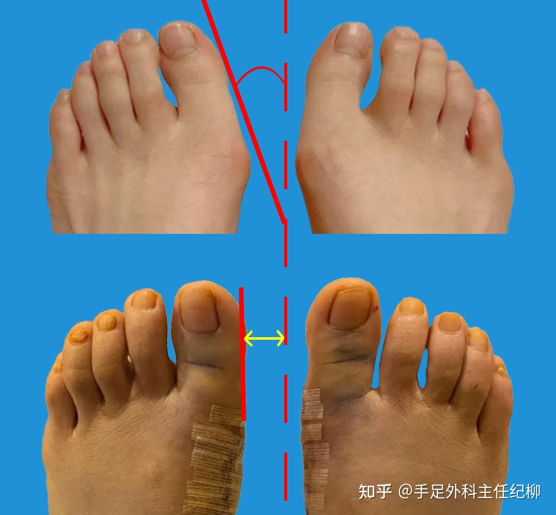 拇外翻导致的疼痛有哪些呢