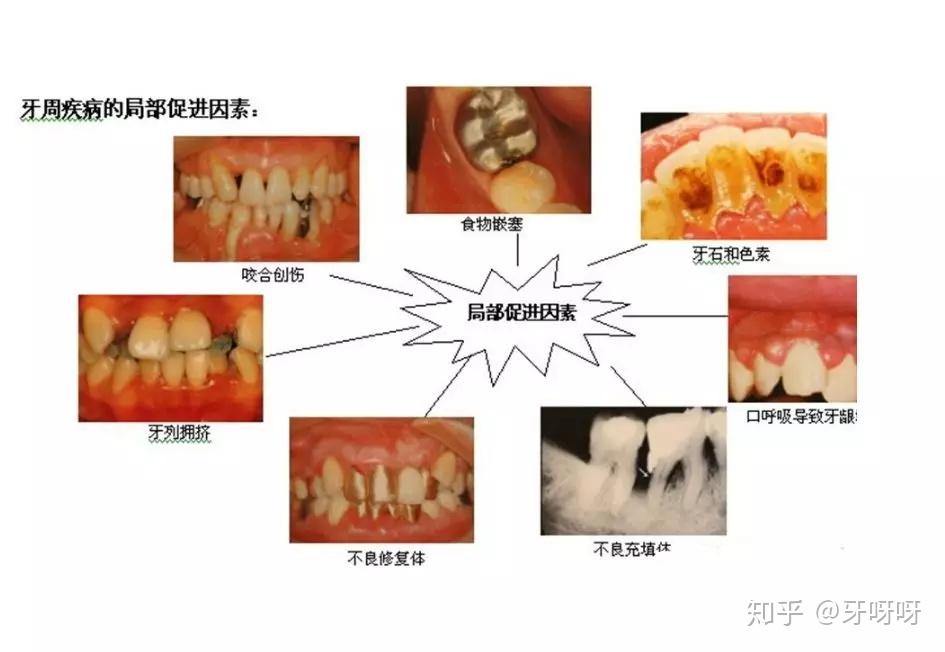可怕的牙周炎,拿什么来拯救我的牙? - 知乎