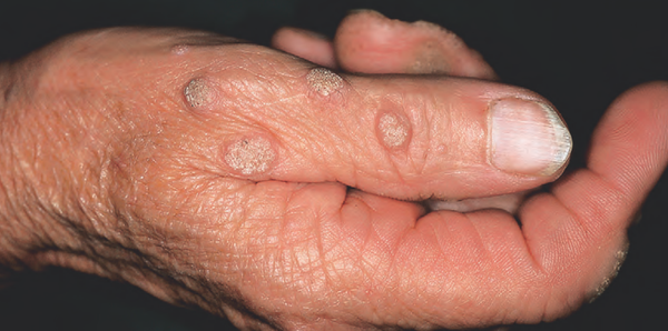 关于病毒疣的一切