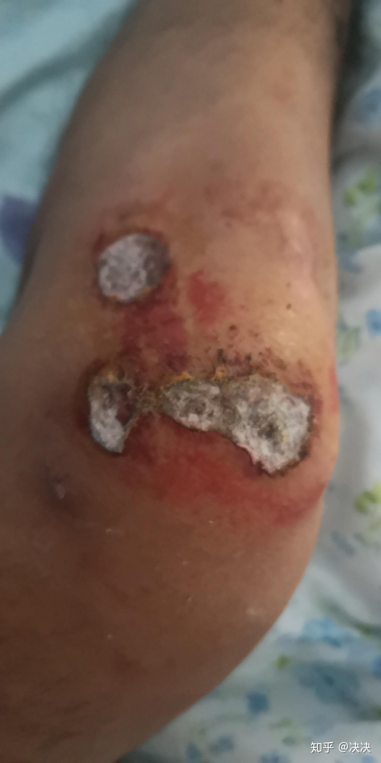 破皮伤口结痂白色 上面有絮状白毛 之前有浓稠液体流出? - 知乎