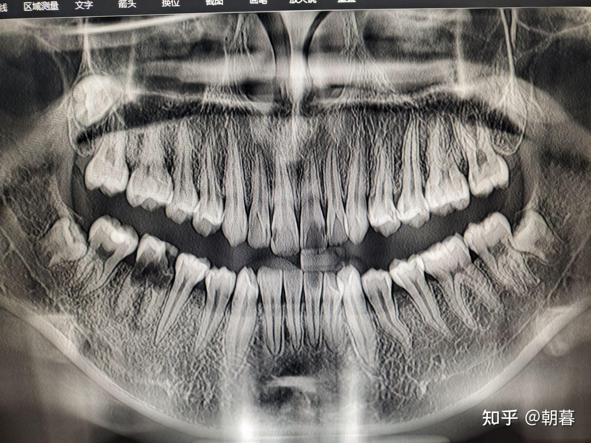 《补牙》牙齿情况(1)