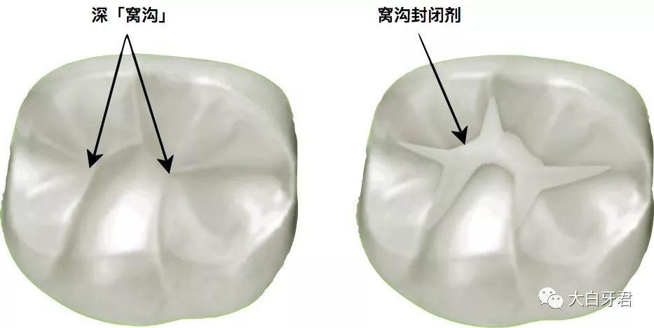 在不损伤牙体组织的前提下(不磨牙) ,将窝沟封闭材料涂布于牙齿咬合