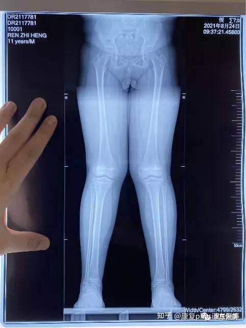 可以明显看到下肢承重位x光片,任同学的膝外翻角很明显,是典型的x型腿