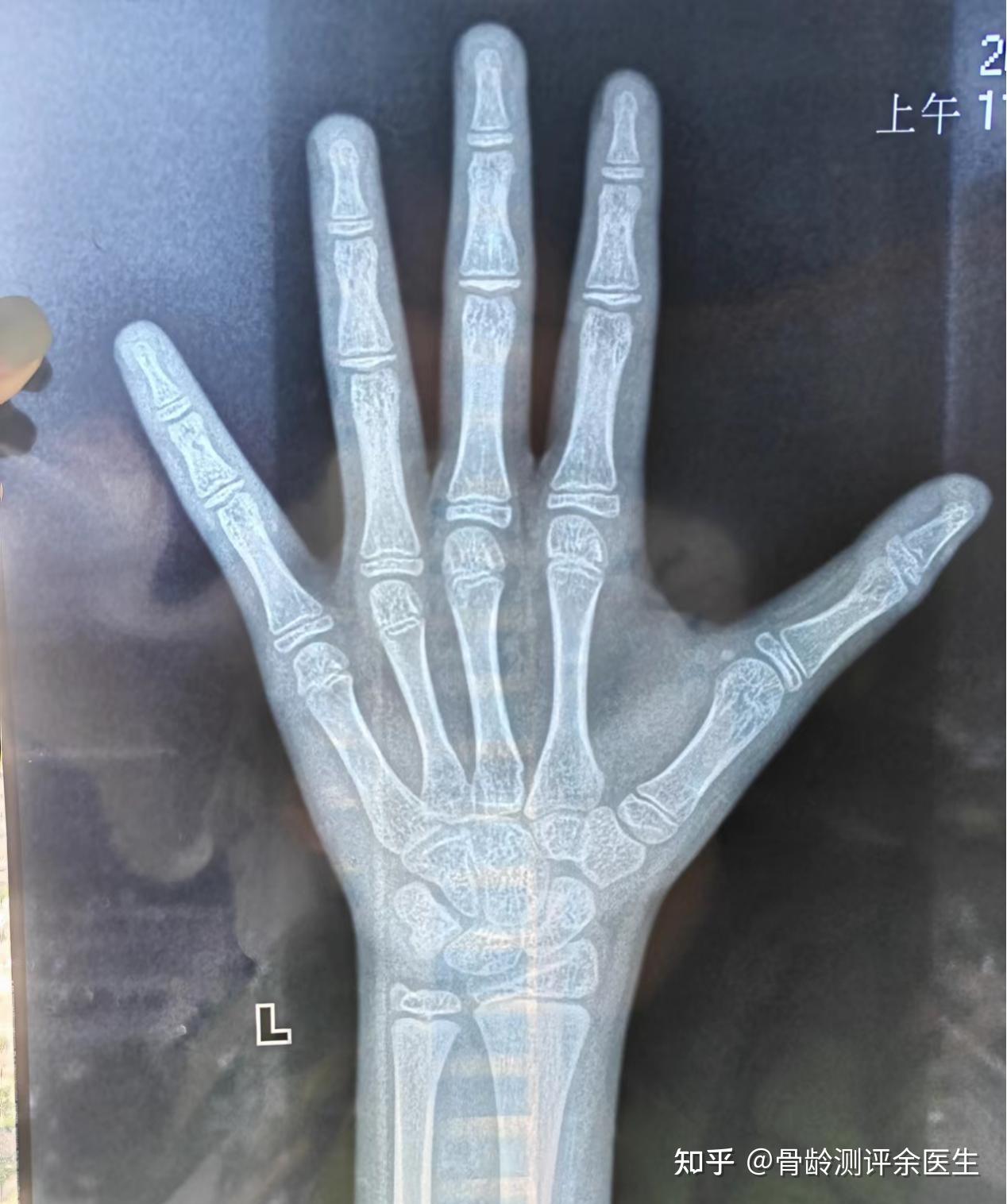 女孩6岁前最好测一次骨龄