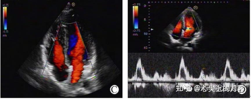 心脏移植的超声心动图评估 - 知乎