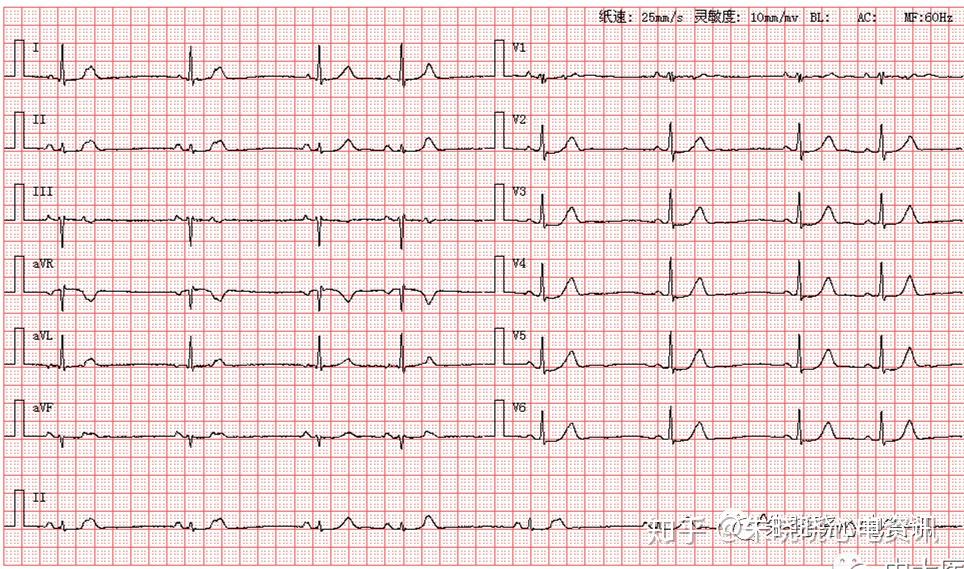 第1114期來源於中大醫院心電圖編輯67第1113期讀圖解析患者男,76歲