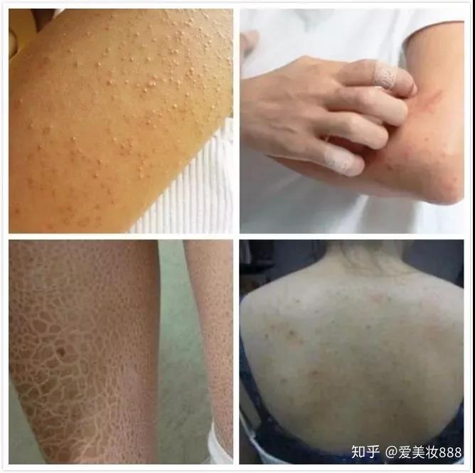 秋天皮肤鸡皮(鸡皮皮肤什么样子)