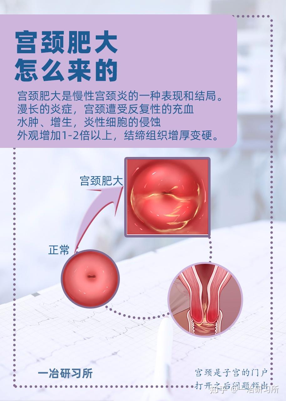 宫颈口炎性增生图片图片