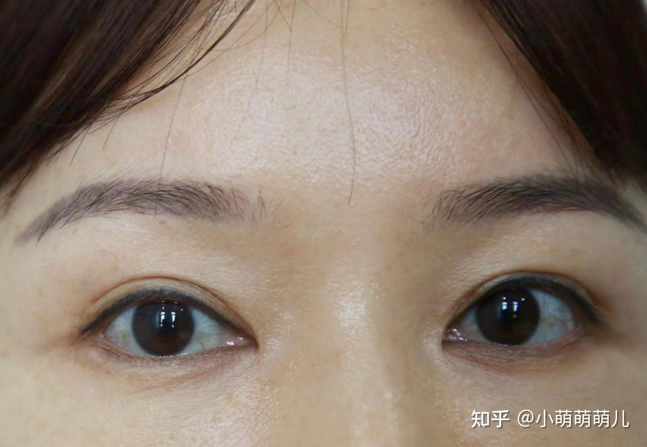 眼里有睑裂斑和红血丝的看过来 - 知乎