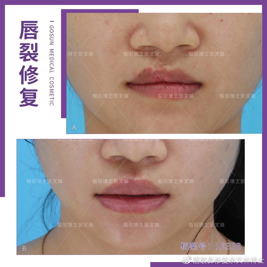 唇红缘与设计线之间切除一条全厚皮肤,适当向下分离红唇缘黏膜并将其