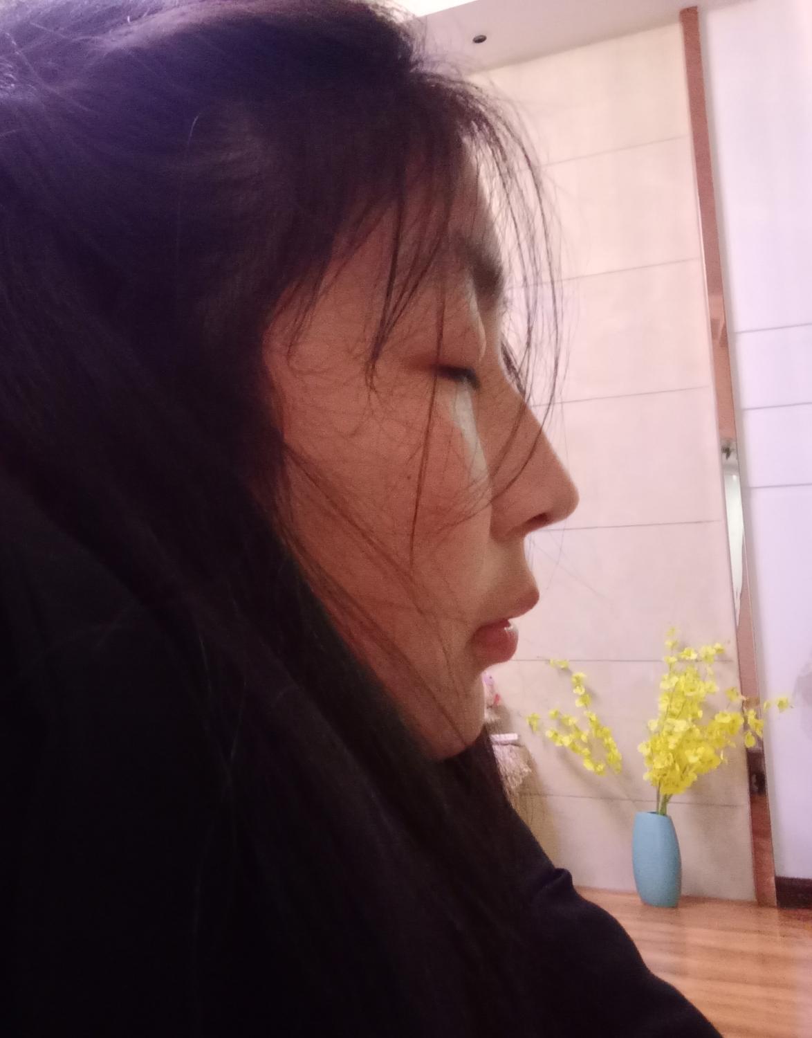 侧面看眼睛非常突眉骨低和鼻子连接不起来是怎么回事