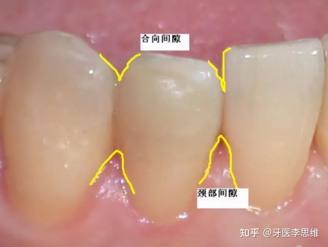牙齿出现黑三角怎么办真的是不可逆的吗