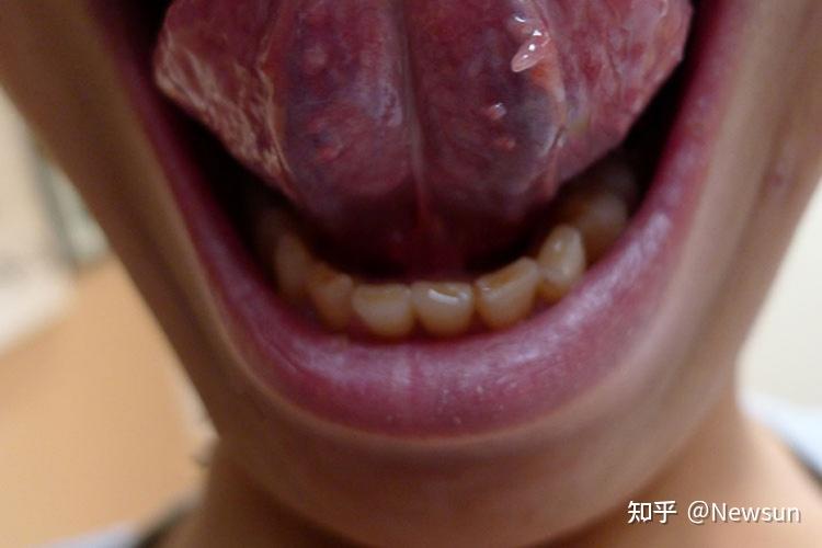 舌部感染hpv小结节状疣图舌头上的尖锐湿疣初发损害为小而柔软的粉红