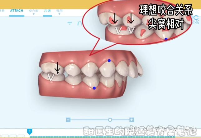 青少年下頜後縮咬合不對位能用隱適美矯正嗎從視頻看你的牙齒是怎樣被