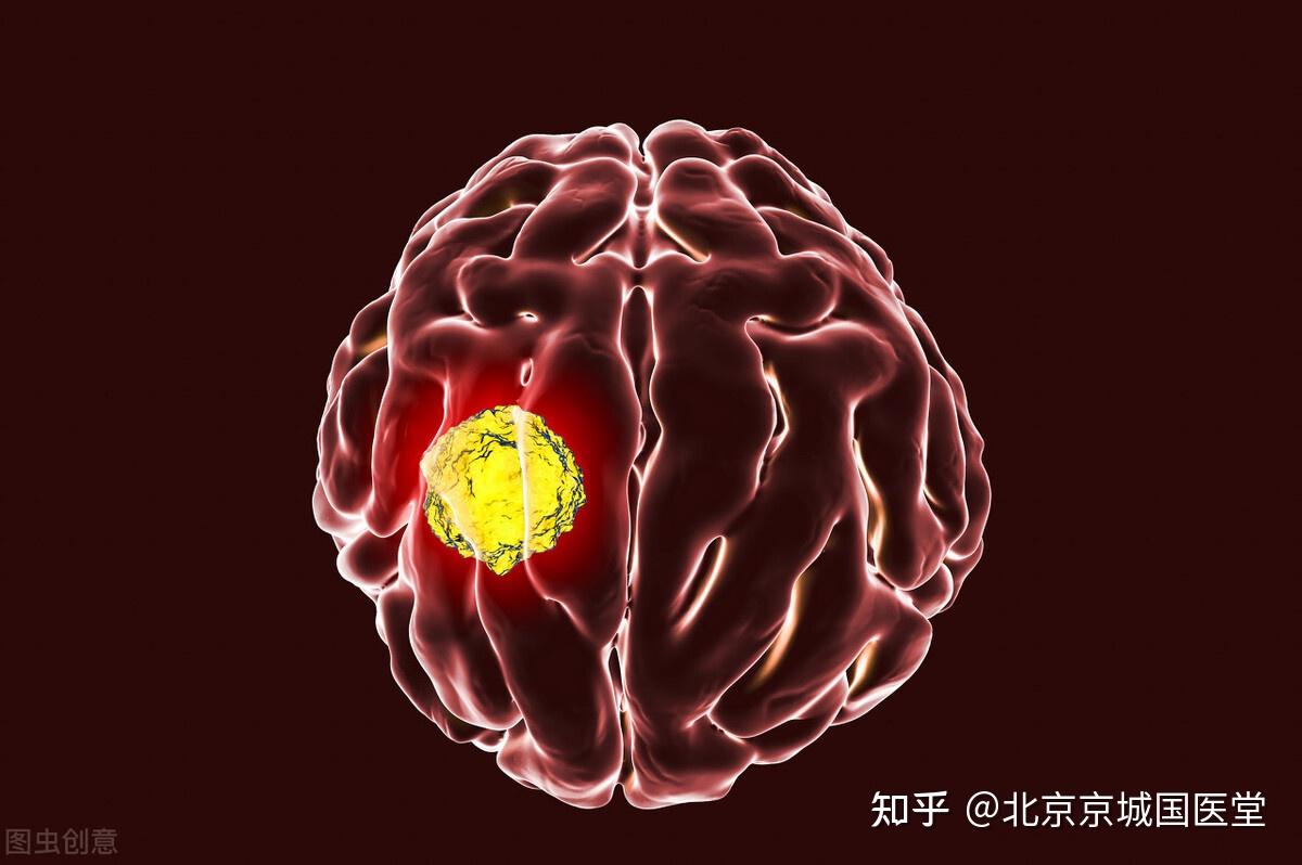 脑癌患者的护理有哪些脑癌患者的护理措施有哪些