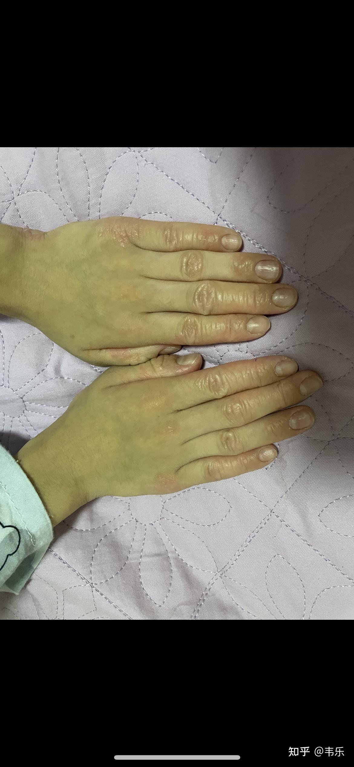 特应性皮炎宝宝治疗历程2