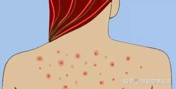 身体背部为什么也会长痤疮？怎么预防背部长痤疮？ - 知乎