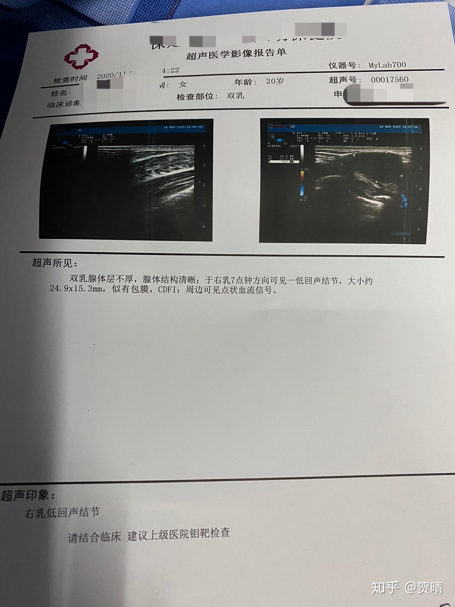 乳腺纤维瘤手术记录