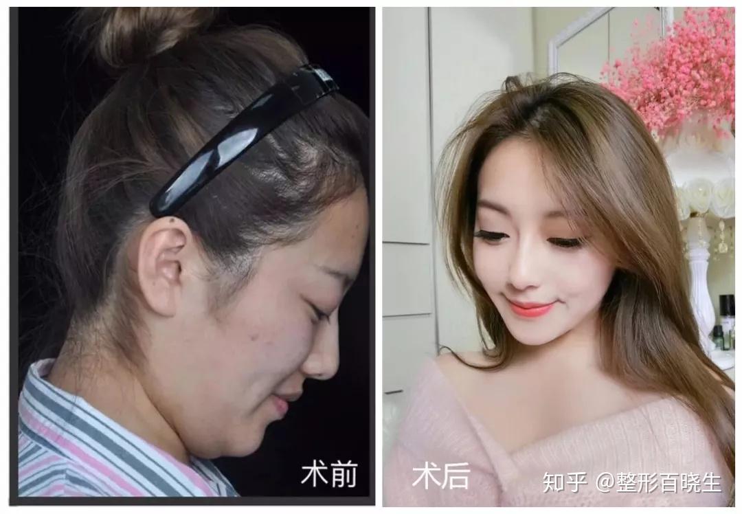 膨体下巴 下颌缘吸脂是种什么体验?案例反馈