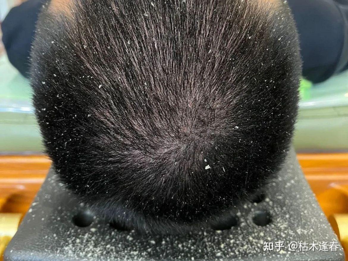 在皮肤科医生看来,拯救一个长期头皮屑泛滥的人,最快最好的方法是什么? - 知乎