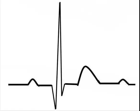 低位窦性心律的心电图特点