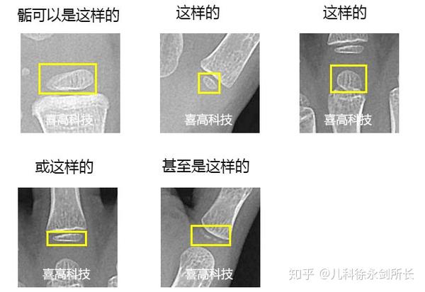 学习中华05标准骨龄鉴定的基础知识 - 知乎