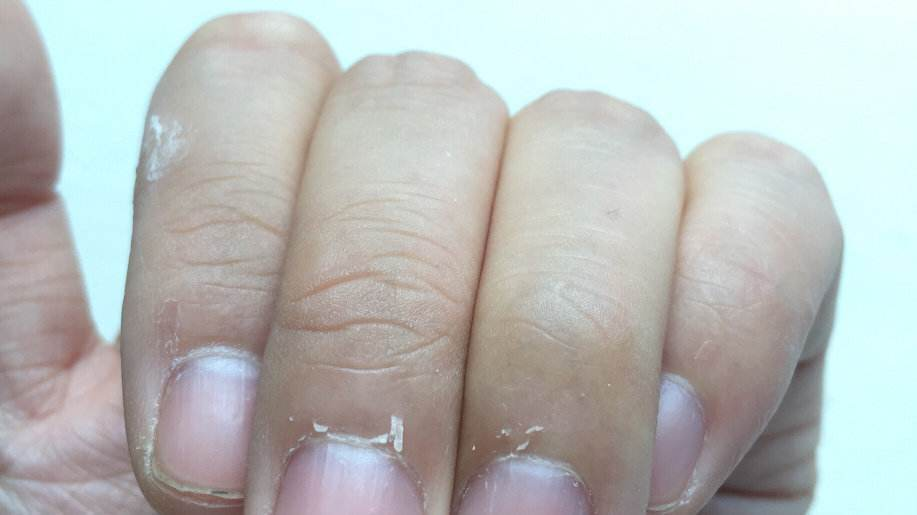 知名女演员拔手指倒刺做手术引发热议医生紧急提醒不要乱拔