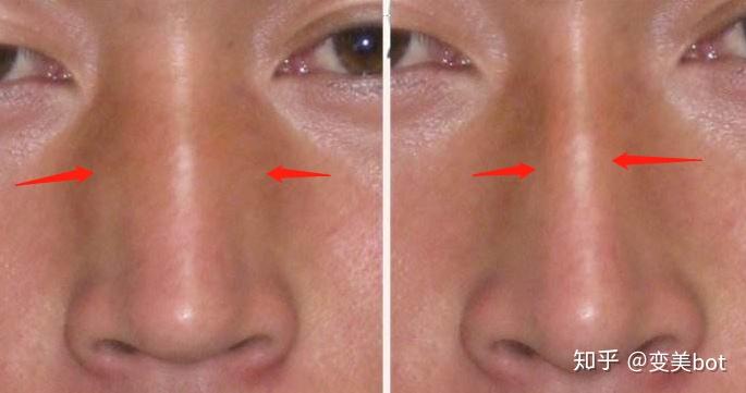 塌鼻子一定要隆鼻吗隆鼻和鼻综合有什么区别吗