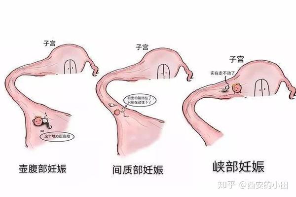 都是宫外孕 为啥有的可以保守治疗 有的就得切输卵管 知乎