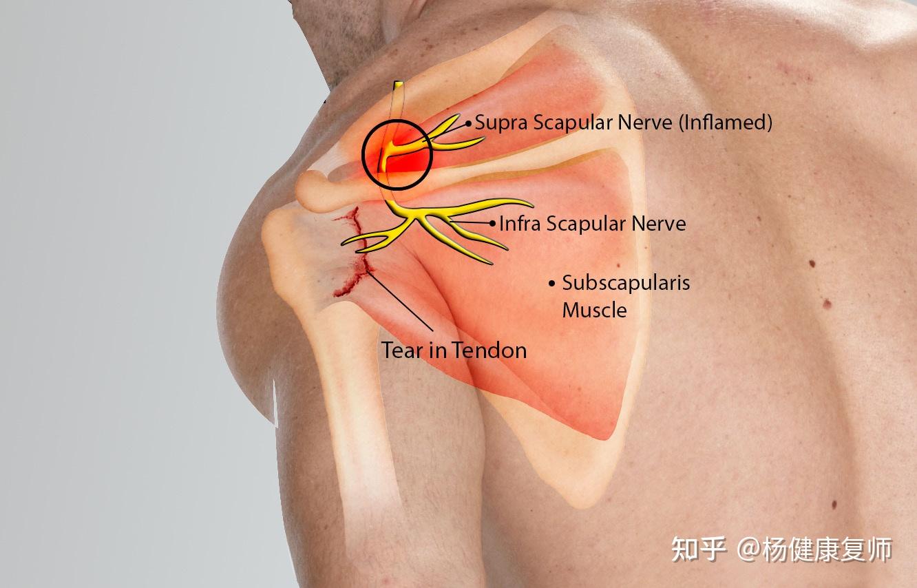 scapular spine图片