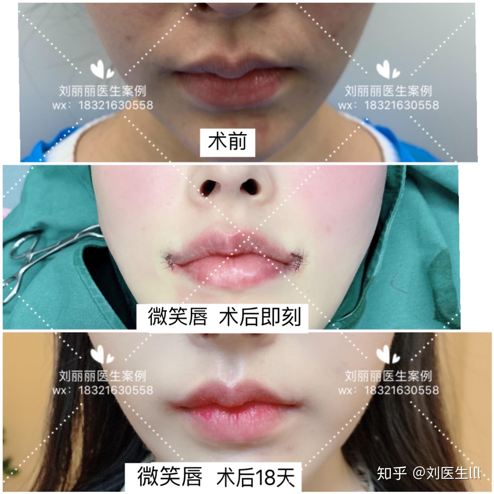 唇综合# #花瓣唇# #微笑唇# #m唇