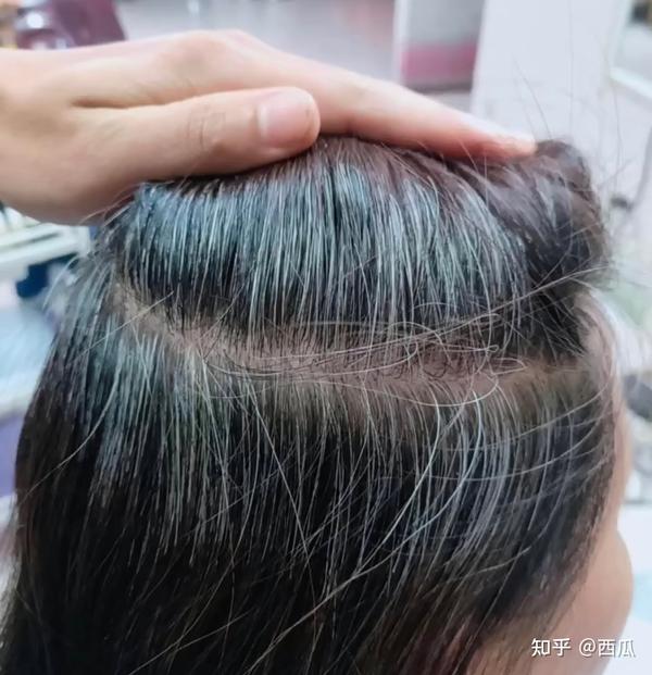 分享我遗传的少白头逆袭之路!! - 知乎
