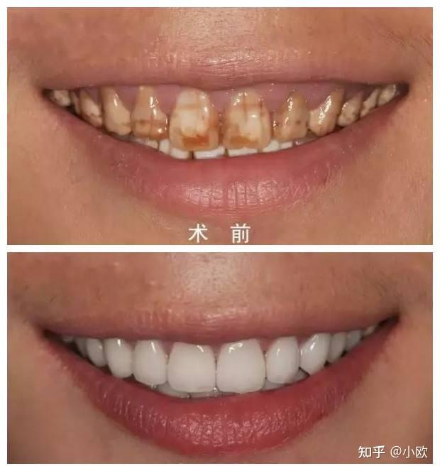 什么是牙齿脱矿?牙齿脱矿该怎么办? - 知乎