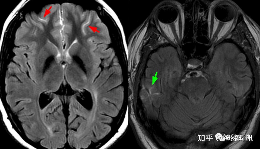 三,flair序列诊断少量sah的常见误区综上所述,对于少量sah的诊断,mr优