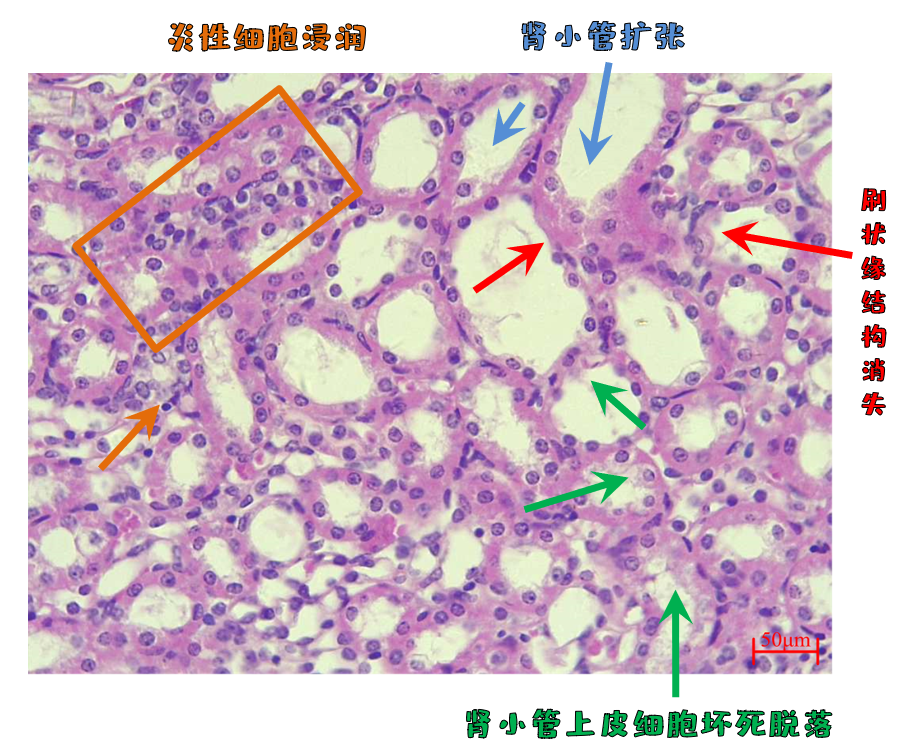 病理切片结果显示:部分肾脏出现肾间质炎性细胞浸润,远端肾小管扩张
