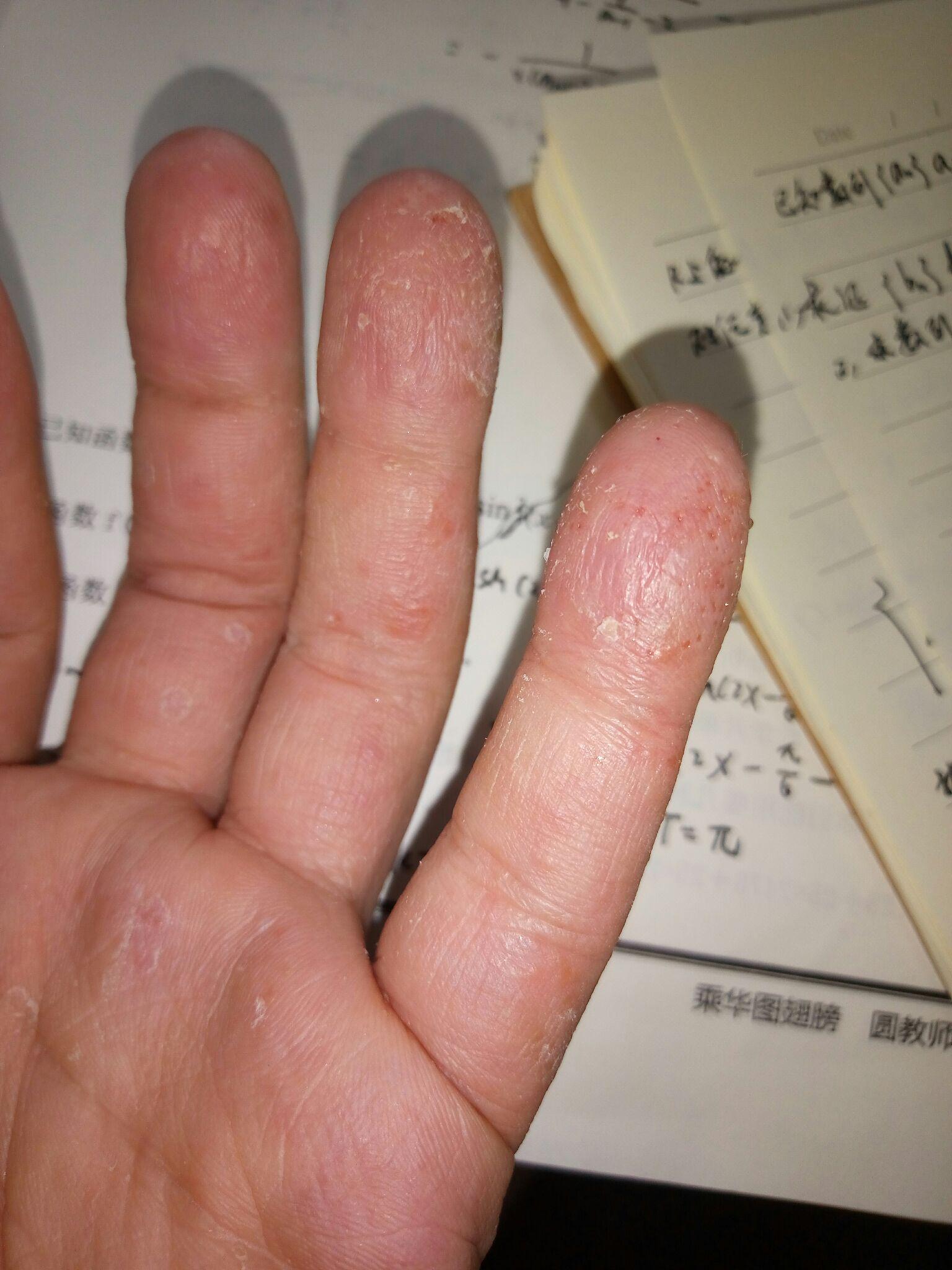 每年春天手上都会长类似水泡但比水泡小很多的泡泡,微微有点痒,然后会