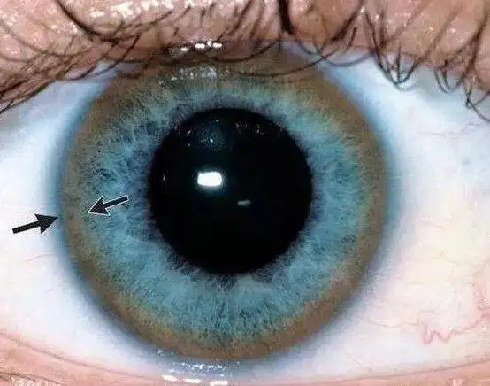 kayser-fleischer ring(k-f环):具有神经系统和精神病学障碍症状的