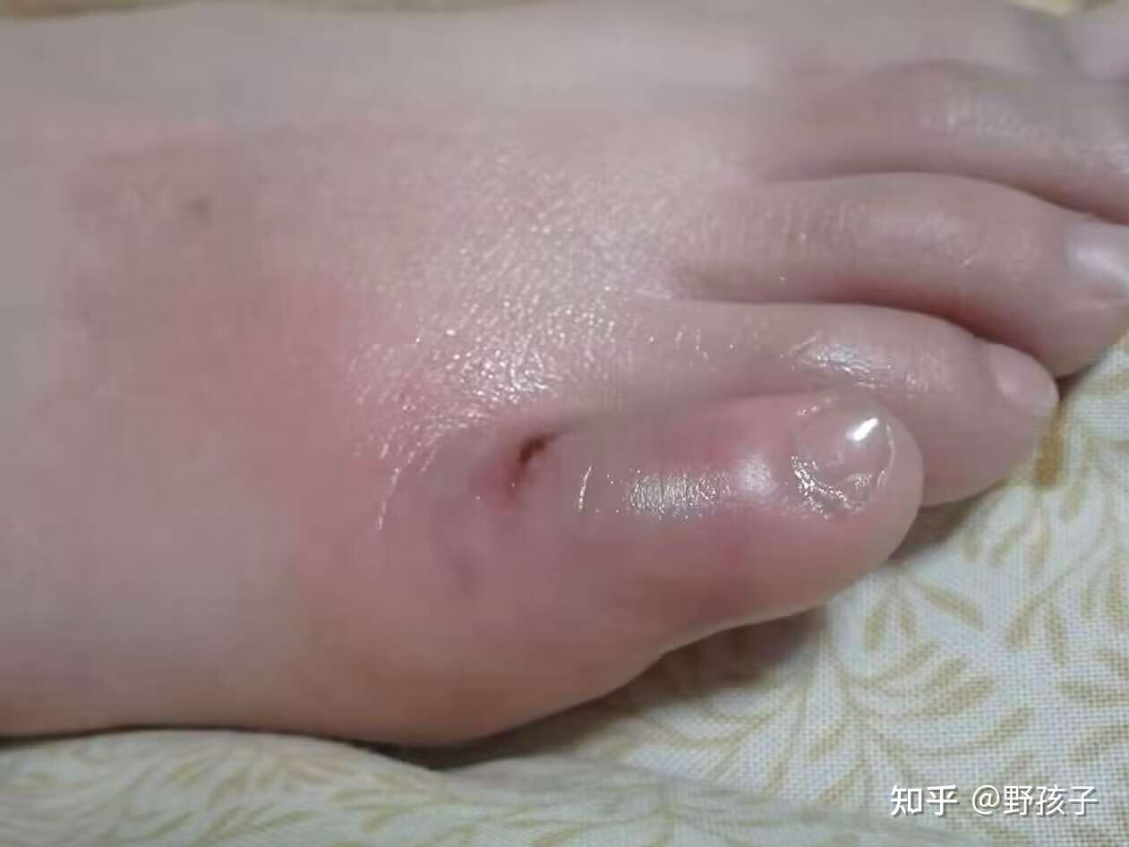 脚冻疮是哪样的