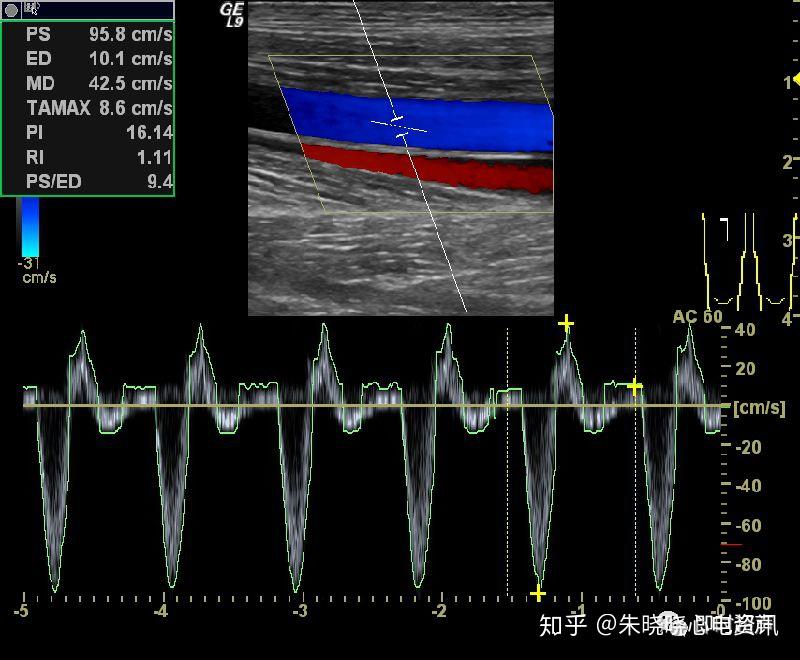 血管超声检查技术 知乎 2585