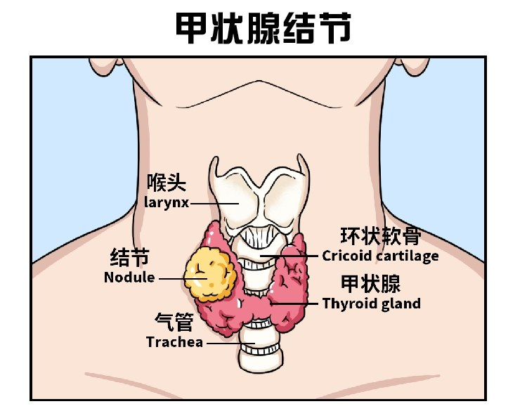 甲状腺结节多长在喉结下方,气管两旁的甲状腺内,它的主要作用是分泌