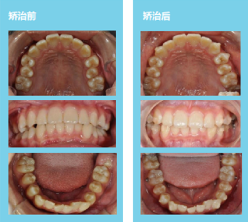 隐形牙套真的可以矫正牙齿吗