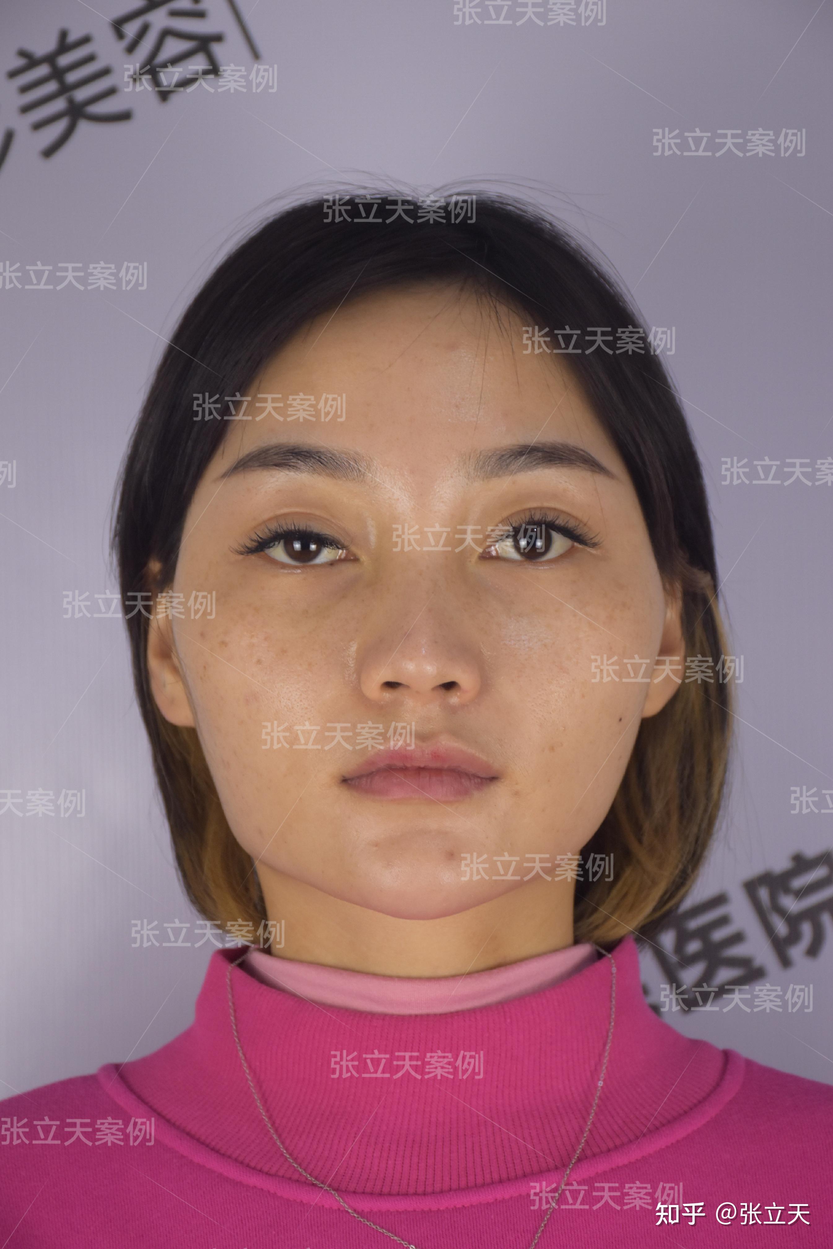 面部轮廓整形案例分享