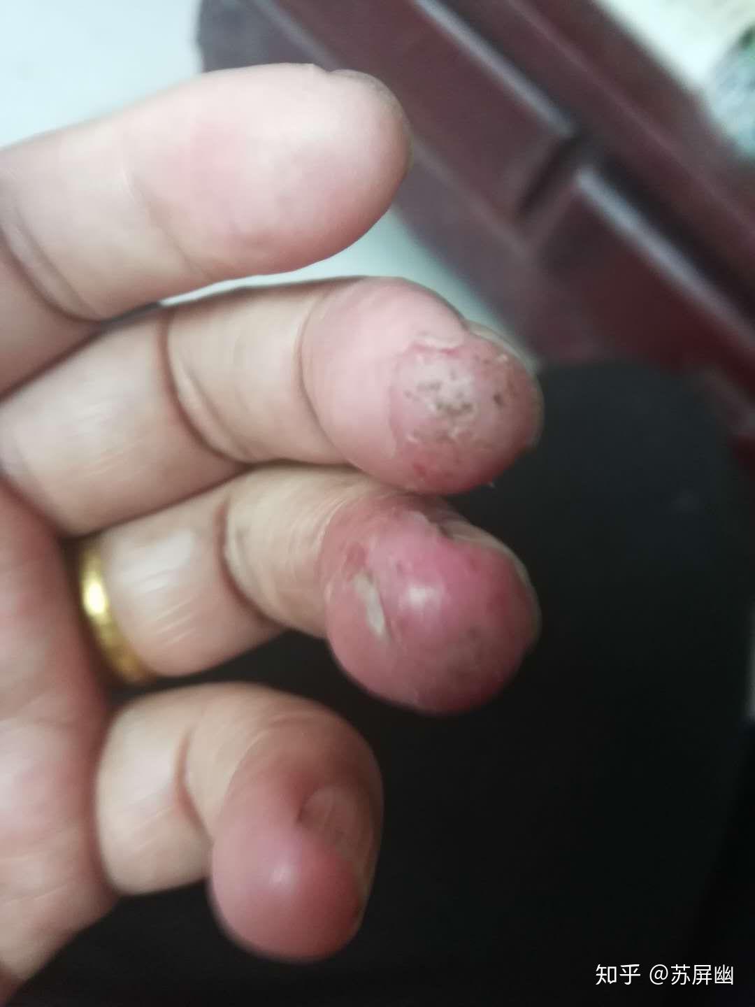 手癣,鹅掌风,顽固性湿疹