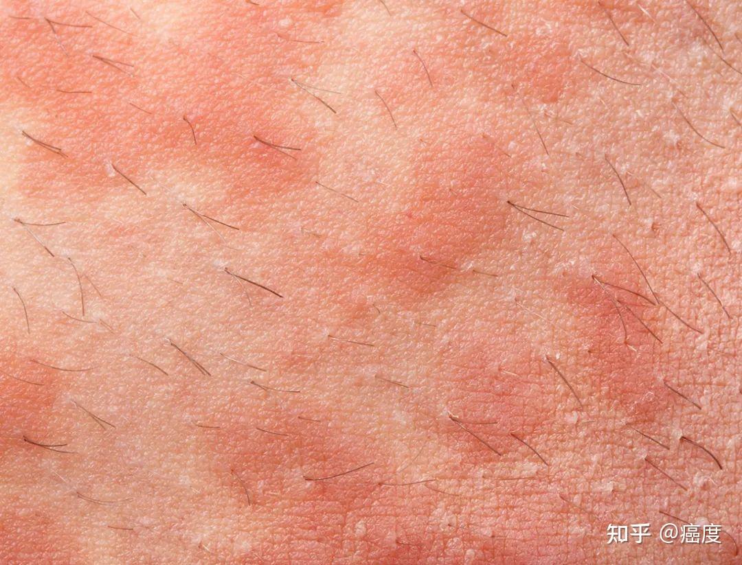 95的癌症患者会有放射性皮炎，小细菌竟是元凶？简单省钱的抗菌治疗即可解决问题 知乎